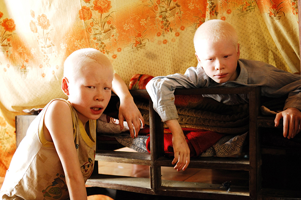 Vietnamese Photographer Cuong Do Manh Documents Albino Twins – Kana Kukui