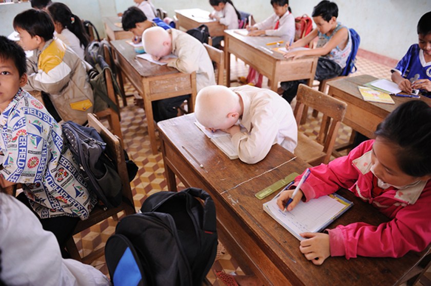 Albino twins studying at school